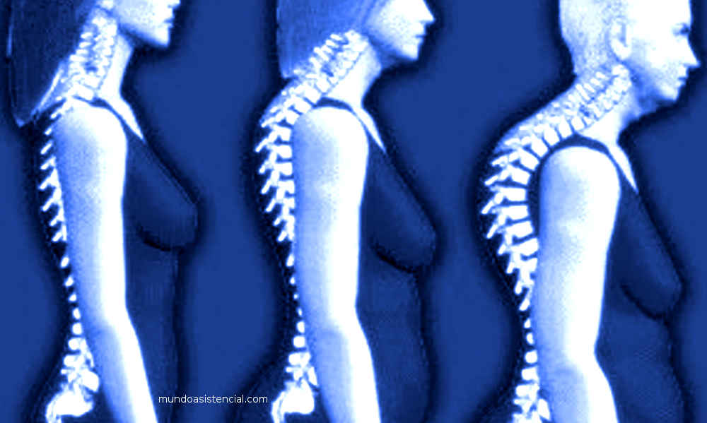 La Menopausia y la salud de los huesos - El natto y la vitamina K2