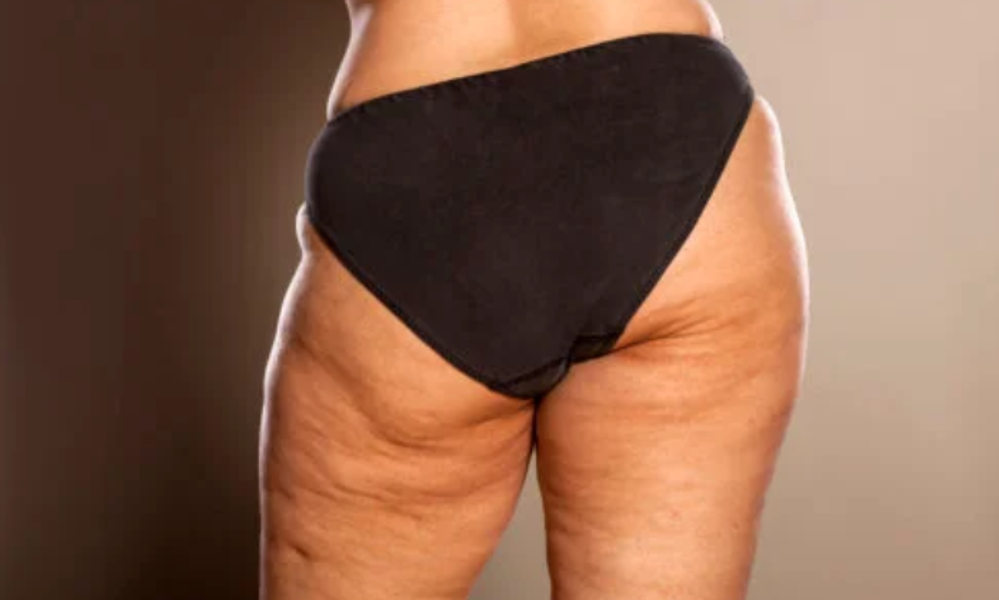 Técnicas contra la celulitis