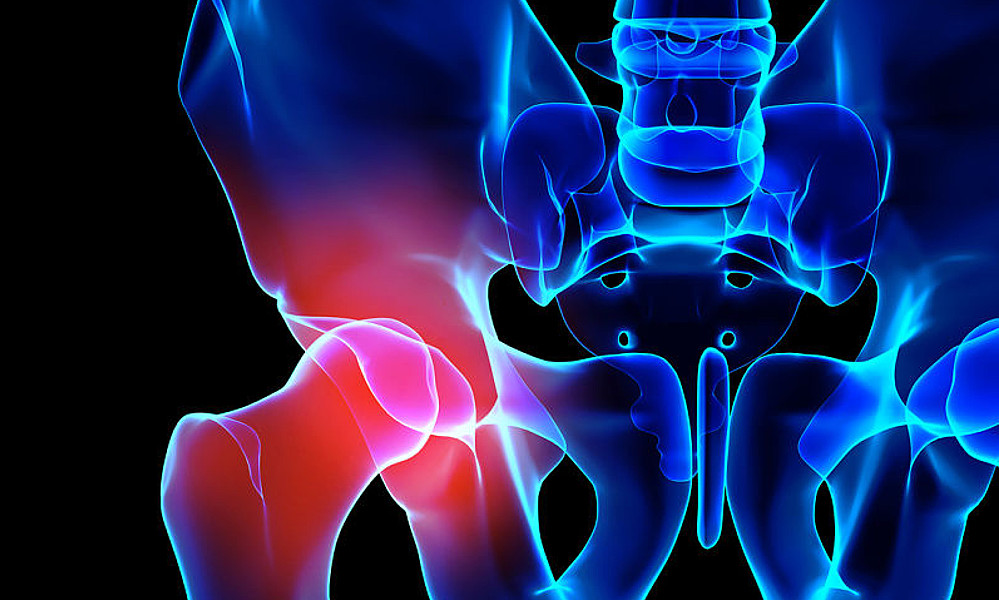 Rotura de cadera - Después de la lesión aumenta la mortalidad