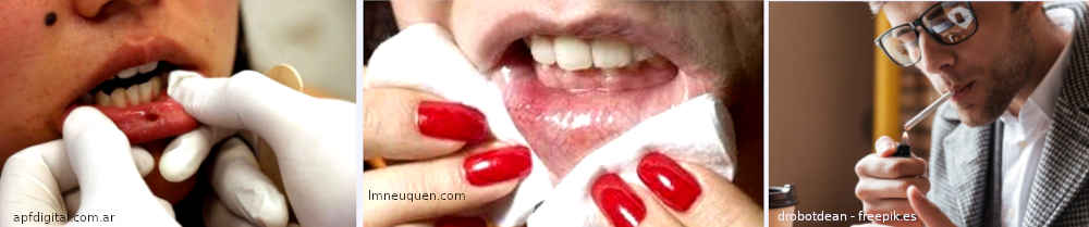 Cáncer bucal - El tabaco y el alcohol son el mayor riesgo