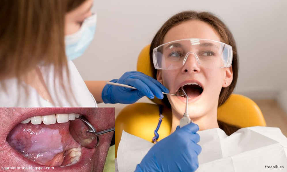 Cáncer bucal - El tabaco y el alcohol son el mayor riesgo