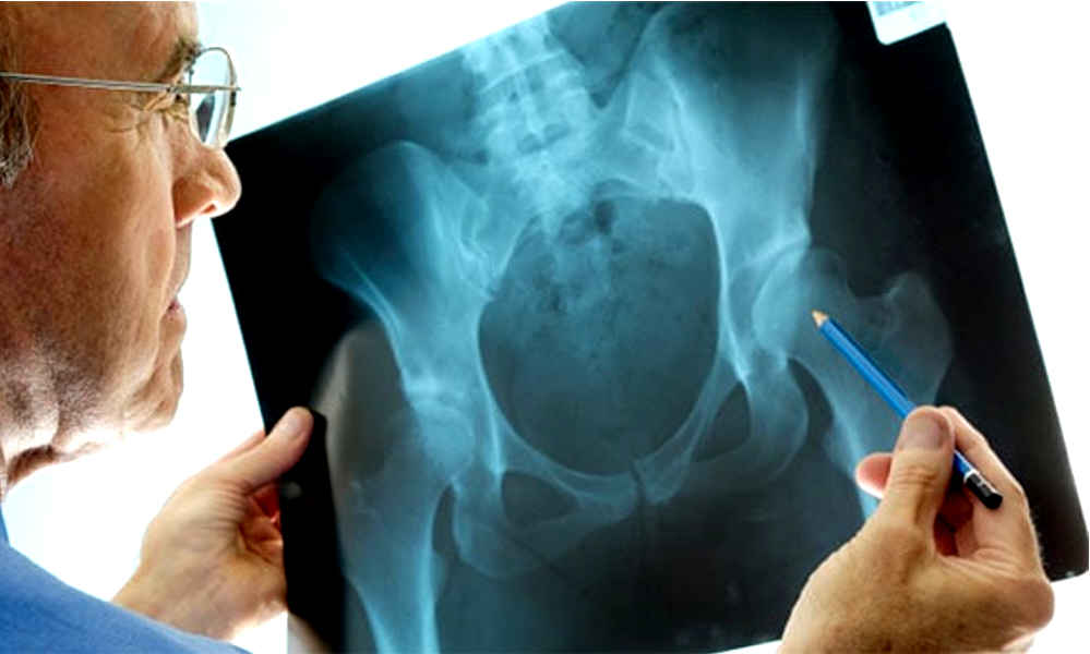 Fractura de cadera - El 30% de los pacientes fallece en un año