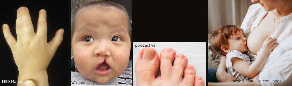 Nicaragua y el pesticida Nemagon 2 - Malformaciones y contaminación del agua